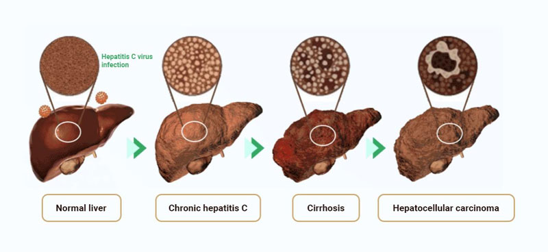 The-Risks-of-Hepatitis-C-Virus-HCV-Infection.jpg